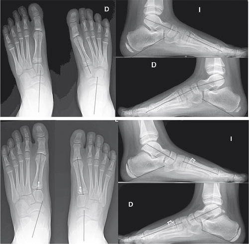 Figure 3. Radiographs of both feet taken preoperatively at 7 years 8 months (top), and postoperatively (bottom, same patient 18 months after surgery), to evaluate correction. On each radiograph the following angles were measured: on the AP standing view, the talus–1st metatarsal angle, and on the lateral standing view Meary’s angle and the calcaneal pitch. Note that the initial involvement was asymmetrical, with the right foot more involved than the left. By 18 months, both feet show signs of hypercorrection.