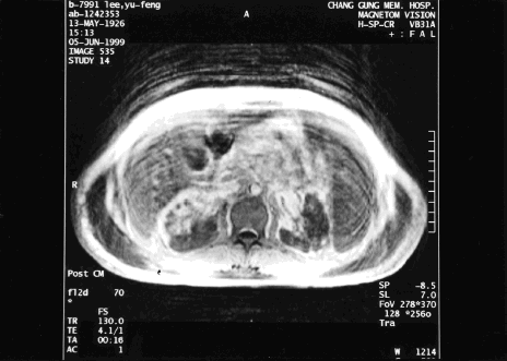 Figure 3. Magnetic resonance imaging and magnetic resonance angiography showed infarction in bilateral kidneys. The involvement of left renal artery was more severe with complete obliteration of left renal artery. Partial occlusion of right renal artery with preserved upper polar artery and capsular eatery was also found.