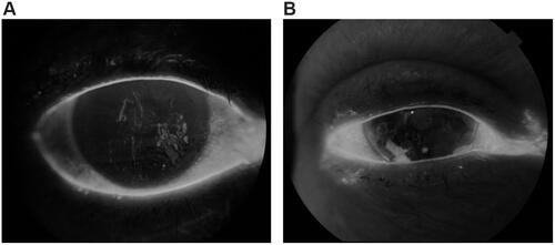 Figure 5 (A, B) Eyes with DES.