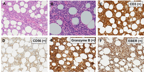 Figure 2 Histological and immunohistochemical staining of the tumor cells. (A and B) Monomorphic medium-sized lymphoid cells with angiocentric pattern (hematoxylin and eosin stain; original magnification ×100 [A] and ×200 [B]); Immunostaining for CD3 (C), CD56 (D), granzyme B (E), and EBER by in situ hybridization (F) (original magnifications ×100).