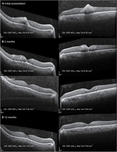 Figure 2 Serial spectral domain OCT images, with image registration, through the fovea at presentation (A), 2 months (B), 3 months (C), and 12 months (D).