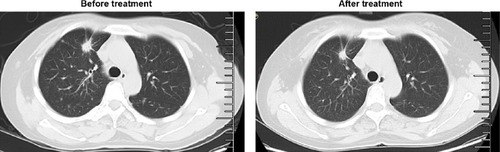 Figure 1 Computed tomography scan of the lung before and after 14 months of gefitinib treatment.