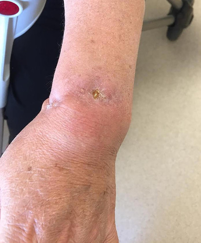 Figure 2 After 12 months course of antituberculous treatment. Swelling, redness and cutaneous fistulization on the left wrist recovered.
