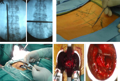 Figure 1 Preoperative localization and anterior cervical discectomy and fusion.