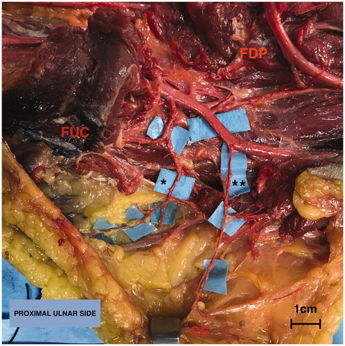 Figure 2. Anatomy of the upper limb in the proximal third (volar side) focusing on the ulnar artery (UA). Overturning proximally the insertion of the flexor carpi ulnaris muscle (FUC), the first tract of the UA is exposed running on the flexor digitorum profundus muscle (FDP): it gives firstly the recurrent branches on the ulnar edge, following by the common ulnar interosseous division on the radial side. Secondly, between its the proximal and middle third the UA gives a further branch on the ulnar side (**). Legend: (*) Anterior recurrent ulnar perforator artery, (**) direct ulnar perforator artery, cutaneous end point (CE), flexor carpi ulnaris muscle (FUC) and flexor digitorum profundus muscle (FDP). Scale bar (1 cm).