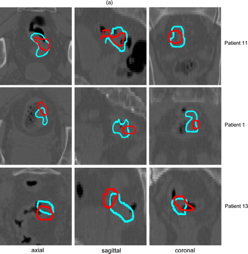 Figure 3.  FDG-PET (blue) and corresponding FMISO (red) (a) or FLT (red) (b) tumour contours in axial, sagittal and coronal plane for 3 patients, showing a good, average and poor overlap between both imaging modalities (from top to bottom).