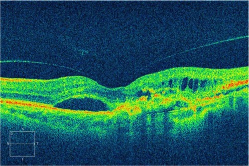 Figure 12 The combination of a pigment epithelium detachment with accompanying subretinal fluid and intraretinal fluid may be a sign of choroidal neovascularization or retinal angiomatous proliferation, in this Cirrus™ optical coherence tomography image.