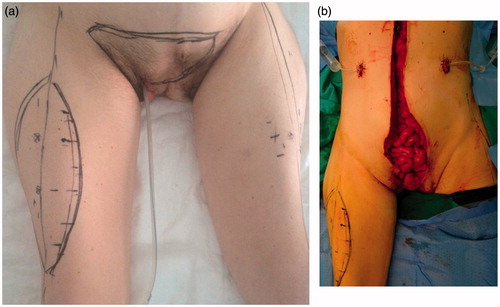Figure 1. Preoperative view (a) and large abdominal wall defect after resection of the tumor (b).