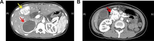 Figure 1 Enhanced CT scan of the abdomen (patient one) revealed a mass in the right adrenal gland measuring 7.9cm×5.6cm×8.8cm, which showed obvious enhancement on the arterial phase and a non-enhancing necrotic center, consistent with a pheochromocytoma (A) (the red arrow). The scan also showed multiple metastases in the pancreas (the largest measuring approximately 6.0m×6.0cm×5.7cm, with irregular enhancement on the arterial phase) (B) (the red arrow), and possible multiple liver metastases (A) (the yellow arrow).