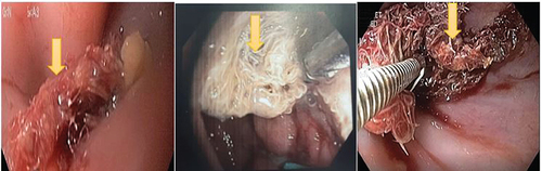 Figure 5. Upper endoscopy showing a narrowed cardia with a 10 mm loss of substance on the right edge blocked by a textiloma (yellow arrow).