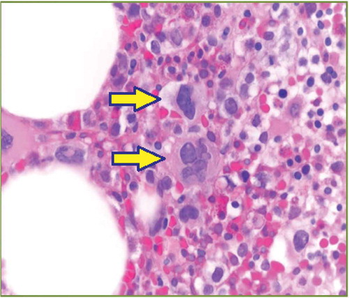 Figure 1. Dysmegakaryopoiesis: hyper- and hypo-lobulated nuclei (solid arrows).