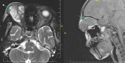 Figure 2 Orbital MRI showed space-occupying that’s T1-isointense and T2-hyperintense heterogeneous lobulated lesion with central signal void in the right intraorbital region resulting exophthalmos.