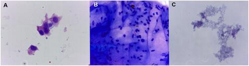 Figure 4 Cells revealed from needle tip aspirates after IVIs were performed on rat eyes. Conjunctival epithelial cells (A), ciliary body epithelial cells (B) and granulated basophilic protein sediments (C) were found in aspirates taken from both needle types (magnification 400×, staining with azure-2–eosin). (Created by L. Lytvynchuk.)