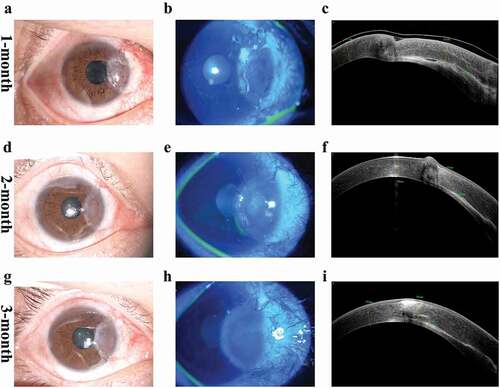 Figure 3. Postoperative slit-lamp ocular images, blue fluorescein staining, and AS-OCT black and white images at 1 month, 2 months, and 3 months. (a–c) At one month, the graft showed edema, fluid leakage at the graft-host interface and beginning of neovascularization. (d-f) at 2 months, the edema of the graft gradually vanished, fluid was absorbed and graft was closely attached to the recipient bed. (g-i) At 3 months, the graft had complete re-epithelialization and cornea exhibited a smooth anterior curve.