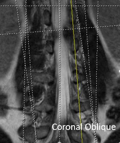 Figure 8 Coronally obliqued sagittals, also called coronal obliques, are parasagittal views obliqued in the coronal plane to bisect the midpedicular locations of L1-L5. Coronal oblique slices, 2 to 3 mm, were obtained medial and lateral to this line.