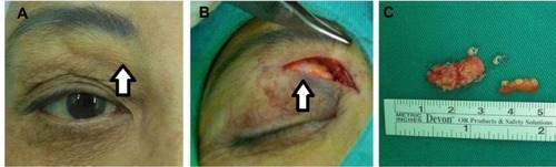 Figure 1 Clinical photographs of the right eye.