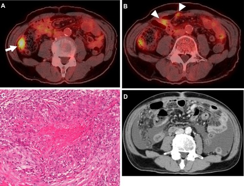 Figure 1 (A, B) 18F-fluorodeoxyglucose positron emission tomography/computed tomography (18F-FDG-PET/CT) detected the presence of an FDG-avid tumor (arrow) in the ascending colon (A) and peritoneal nodules (arrowheads) (B). (C) A biopsied peritoneal nodule showed epithelioid cell granuloma with partial necrosis on hematoxylin-eosin staining. (D) Abdominal CT showed a thickened peritoneum with massive ascites at the onset of tuberculosis peritonitis.