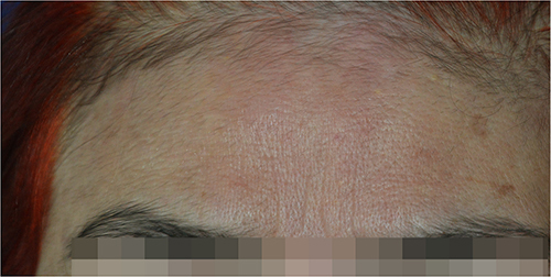 Figure 3 After 30 days after treatment, the white macular rash was completely re-pigmented.