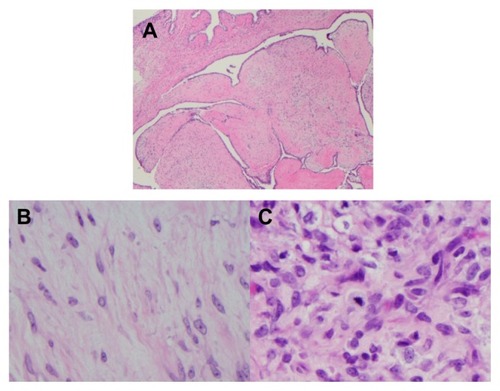 Figure 3 Microscopic examination of the resected specimen (10× magnification) showed a malignant phyllodes tumor with extensive stromal overgrowth (A). The stromal component varied in cellularity, with some areas (50× magnification) having a low-grade appearance (B), while others (50× magnification) had a more high-grade appearance with increased cellularity, nuclear pleomorphism, and numerous mitotic figures (C).