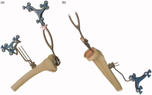 Figure 3. Measurement of positioning accuracy. (a) For the distal femoral resection, the validation tool without the condyle digitizer is applied to the resected surface to acquire the angle; (b) For the proximal tibial resection, the validation tool with the condyle digitizer is applied to the resected surface to acquire the angle.