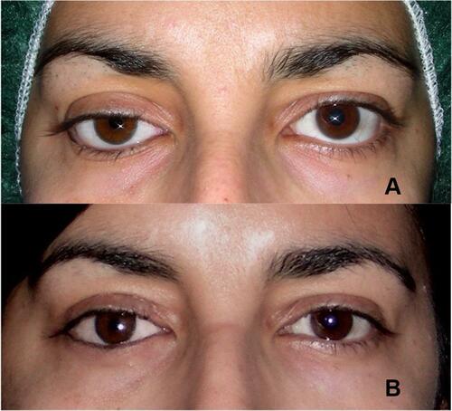 Figure 6 (A) Right ptosis and lower lid laxity following secondary implantation. (B) Ptosis corrected simultaneously with right and left lower lid malpositions. (Image is the property of the authors.