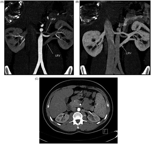 Figure 2. MDCT angiogram in 29-year-old male renal donor with circumaortic left renal vein. Oblique coronal MIP of early arterial (A) and venous (B) phase images illustrate circumaortic left renal vein (arrow). (C) Axial MIP of early arterial phase image reveal retroaortic component (arrow) of circumaortic left renal vein.