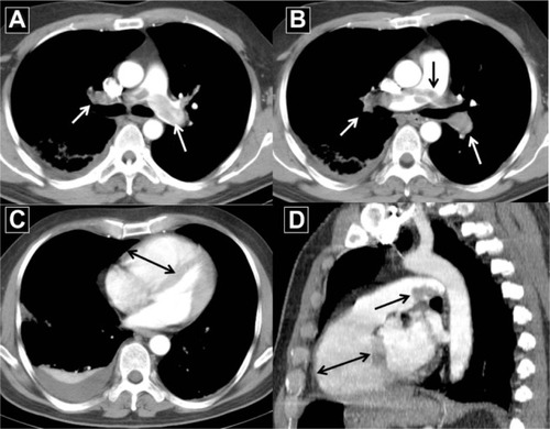 Figure 1 A 48-year-old man presented with intractable tachycardia, acute dyspnea, and systemic hypotension (arrows).