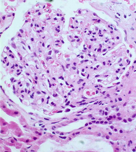 FIGURE 1. Light microscopic view of the renal biopsy specimen.