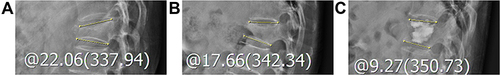 Figure 2 The patient was a 69-year-old woman with a T12 osteoporotic vertebral compression fracture and balloon kyphoplasty was performed. The yellow line indicates the kyphotic angle. The kyphotic angle changed from 22.06° in preoperative standing lateral radiographs (A) to 17.66° in intraoperative prone lateral radiographs (B). So the dynamic fracture mobility was present. After operation, the kyphotic angle changed to 9.27° in postoperative standing lateral radiographs (C). The kyphotic angle correction due to balloon kyphoplasty itself was 8.39°.