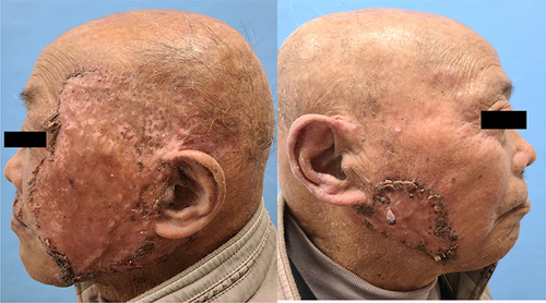 Figure 3 Clinical photos of 7 months after treatment.