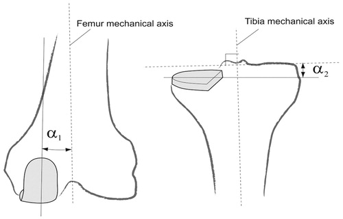Figure 3. Estimation of varus/valgus angles for tibial and femoral implants. The tibial and femoral mechanical axes are estimated using the ground truth positions of the hip center, knee centers, and the ankle center. α1 and α2 are the varus/valgus angles estimated for the femoral and the tibial implants, respectively.