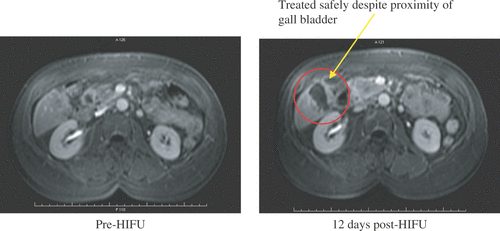 Figure 1. T1-weighted images, 1 min post IV Gadolinium. A patient with metastatic liver disease treated as part of the Oxford trial.