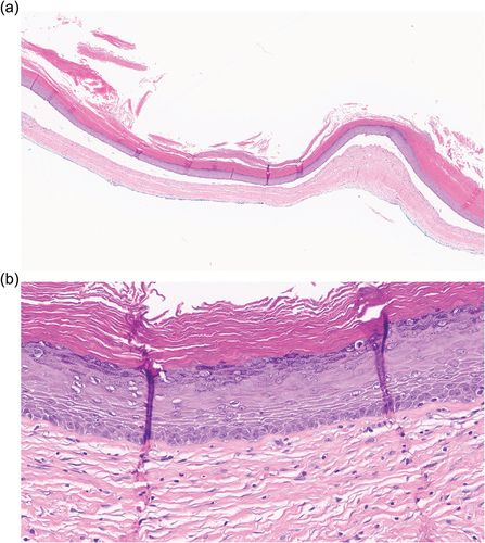 Figure 5. Histopathologic features of an OOC. (a) a thin, regular epithelium with a thick and lamellar orthokeratin layer lines a noninflamed fibrous wall (H&E stain, original magnification x 20); (b) the epithelial lining shows a prominent granular layer; the basal layer lacks hyperchromatic and palisaded nuclei (H&E stain, original magnification x 200).