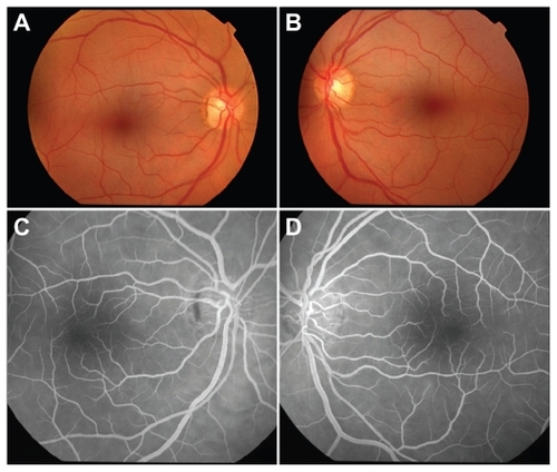Figure 1 Color fundoscopic images of right a) and left b) eyes 72 hours postingestion demonstrating retinal pallor and cherry red spots. Fluorescein angiograms of right c) and left d) eyes 72 hours postingestion revealing normal retinal vessels.