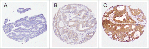 Figure 1. Tumor SQSTM1 (p62) expression in colorectal cancer. Tumor SQSTM1 expression was scored as low (A), intermediate (B), or high (C), according to cytoplasmic expression level of SQSTM1 in tumor cells.