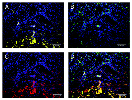 Figure 8. Macrophage phenotype analysis of C-ECM patches at 4 weeks after surgery. Macrophages had completely penetrated the patches and expressed a mix of M1 and M2 cells. (A) M1 macrophages (CD86, yellow; draq5, blue), (B) M2 macrophages (CD206, green; draq5, blue), (C) pan-macrophage (CD68, red; draq5, blue), (D) combined image. Scale indicates 100 µm.