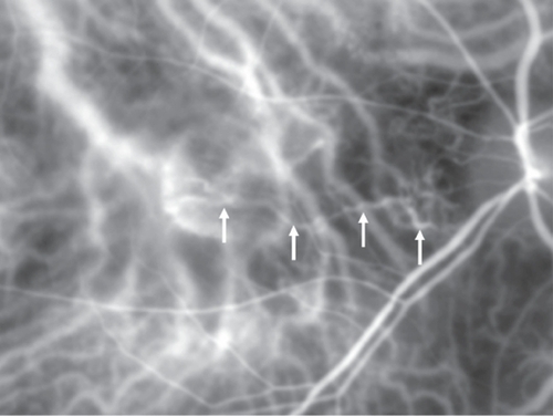 Figure 2 Before PDT, early-phase ICG illustrates a dilated and tortuous feeding complex (arrows) of the subfoveal CNV raised from a deeper choroidal layer.