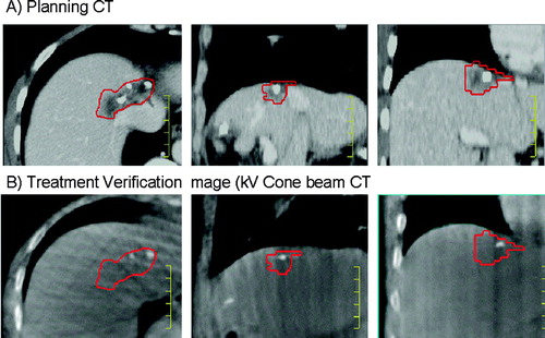 Figure 5.  A) Venous phase planning CT for liver metastases radiotherapy planning, and B) verification non contrast kV cone beam CT acquired for image guidance at the time of radiation delivery, registered to the planning CT. Imaging was acquired in exhale breath hold to immobilize the liver. The calcifications in the tumour were used to facilitate alignment of the liver from the cone beam CT to the liver from the planning CT. The gross tumour volume contour on the planning CT is shown on both images.