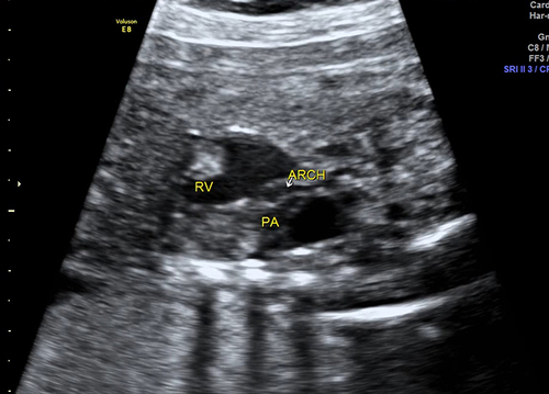 Figure 3 In Case 20, the coarctation of the aorta (CoA) with descending aorta originated from the right ventricle was misdiagnosed by the prenatal ultrasound (white arrow: distortion and narrowing of aortic arch).