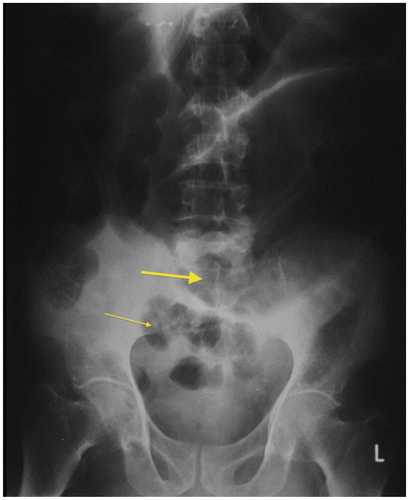 Figure 3b: Plain radiograph of surgically-confirmed ileosigmoid knot showing dilated sigmoid colon with the apex in the left upper quadrant and the point of convergence overlying the right iliac fossa (thick arrow) with dilated small bowel loops in the pelvis (thin arrow)