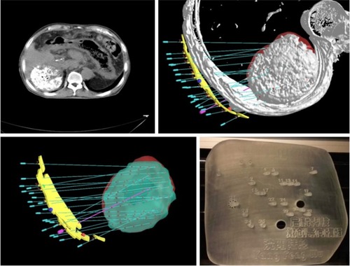 Figure 1 Use of TPS to design the needle-insert and seed-arrangement plane according to CT result for printing 3-D templates.