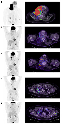 Figure 2 FDG PET/CT maximum intensity projection (left column) and fused PET and CT transaxial images (right column) from the lower neck region.
