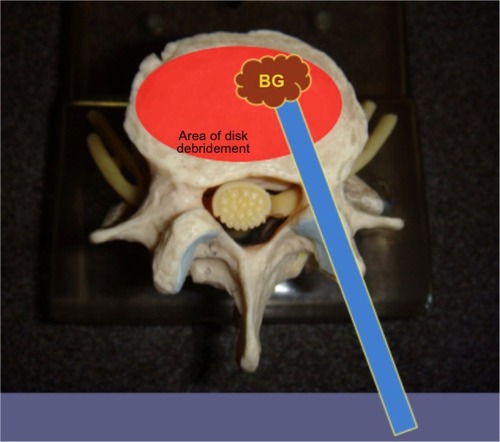 Figure 2 Conventional end-dispensing cannula ejects BG directly in the path of a fusion cage and does not distribute BG into the periphery of the prepared disk space.