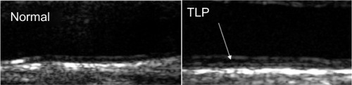 Figure 1 CIMT images showing sample patients in whom TLP (arrow) is absent (left) and present (right).