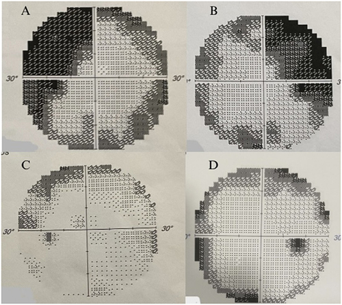 Figure 1 Grayscale maps of Humphrey’s Visual Field Tests conducted prior to surgery (A – Left, B - right), three months after surgery (C – Left, D - Right).