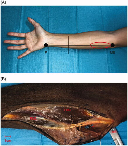 Figure 1. (A) Schematic view of the forearm three segments division. The circles in red highlights the proximal third which is the object of investigation in our anatomical study. P: pisiform bone; ME: medial epicondyle. (B) A volar side, skin incision, parallel of the longitudinal axis of the forearm, was performed in the proximal third. A supra fascial dissection in radio-ulnar direction under 4.0× loupes magnification was conducted to visualize the perforators. FRC: flexor carpi radialis muscle; FUC: flexor carpi ulnaris muscle; ME: medial epicondyle; *: perforator branch. Scale bar (1 cm).