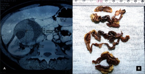 Figure 1 A) Computed tomography of the abdomen shows a retroperitoneal mass in the right anterior pararenal space (transverse cross section). B) Photograph of the gross specimen shows the cyst wall.