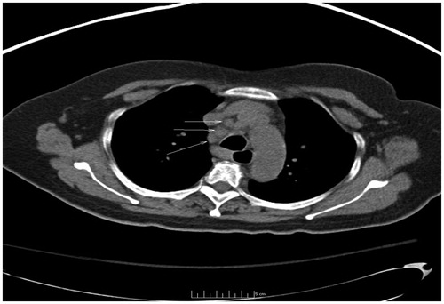 Figure 1. Axial computed tomographic (CT) imaging of chest revealed multiple enlarged mediastinal lymph nodes (arrows), measuring up to 1.1 × 1.8-cm at the right lower paratracheal and paraesophageal region.