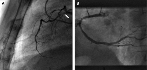 Figure 1.  (A) Left coronary angiogram in lateral projection showing a proximal severe stenosis in LAD with TIMI flow score of 2 (white arrow). (B) Right coronary angiogram in left anterior oblique view showing an atheromatic right coronary artery with a significant stenosis in the posterior descending artery.