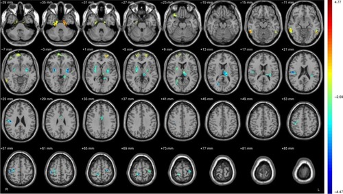 Figure 1 Brain regions showing significant differences on ALFF between Alex and Cont group.